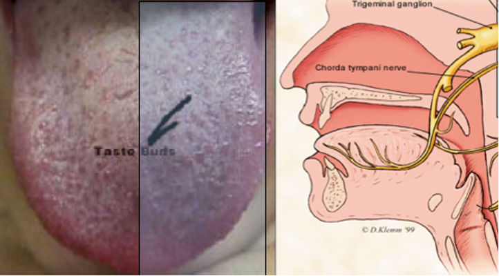 lingual paresthesia from nerve injection