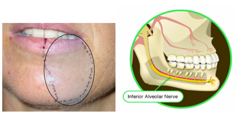 lingual paresthesia from nerve injection